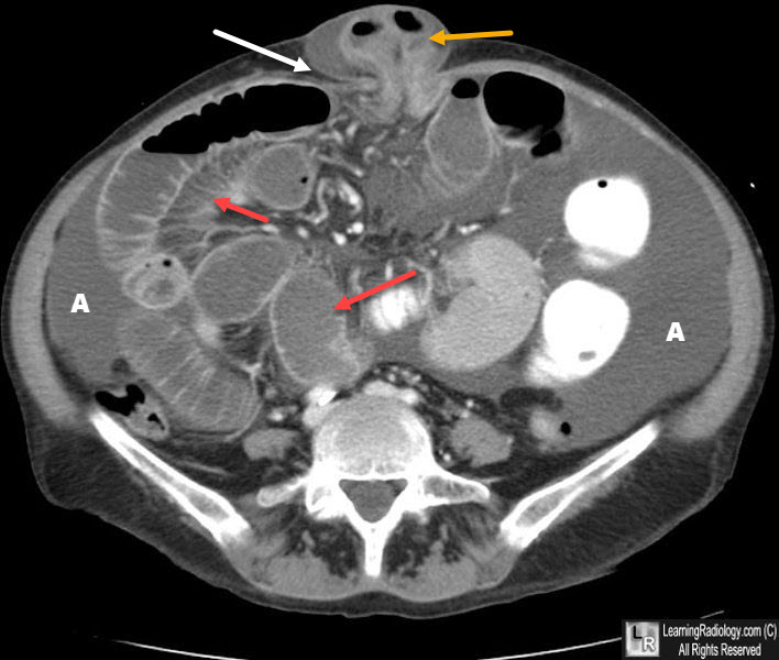 umbilical hernia